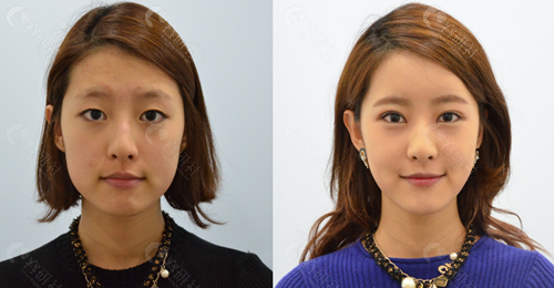 韩国必当归下颌角截骨术前术后对比照片