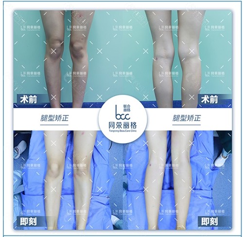 杭州同荣丽格医疗美容医院同荣脂雕光影雕刻直腿术前后对比图