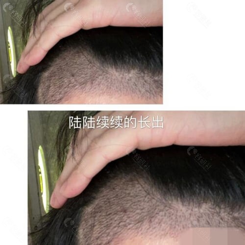 北京碧莲盛植发额角头发种植术后照
