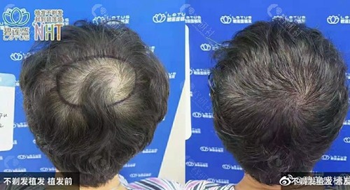 北京碧莲盛做头顶头发稀疏加密种植前后对比图
