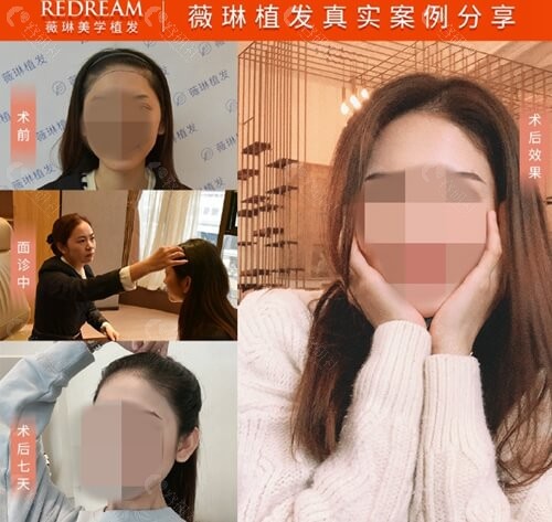 上海薇琳植发发际线种植术后一个月恢复照片