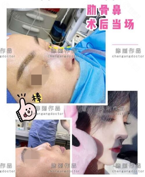 南京美贝尔医疗美容肋软骨鼻综合术后照