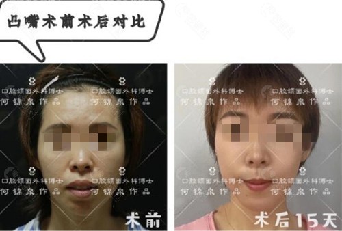广州广大凸嘴正颌手术真人图片