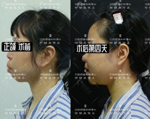 广州广大凸嘴正颌手术前后对比照