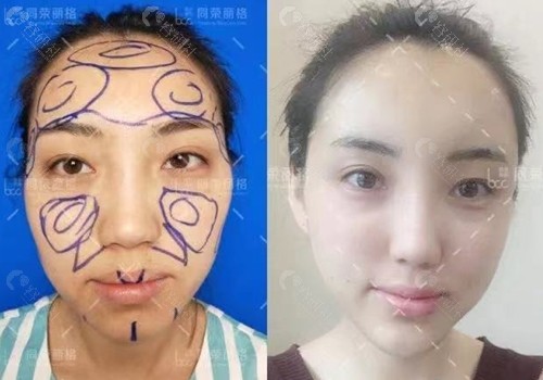 杭州同荣丽格郭同荣自体脂肪填充全脸术前和术后即刻对比图
