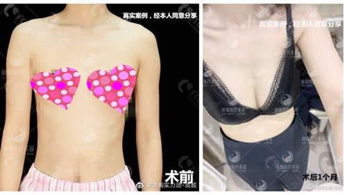 北京丽都医疗美容医院高超医生真人假体隆胸术前术后对比图