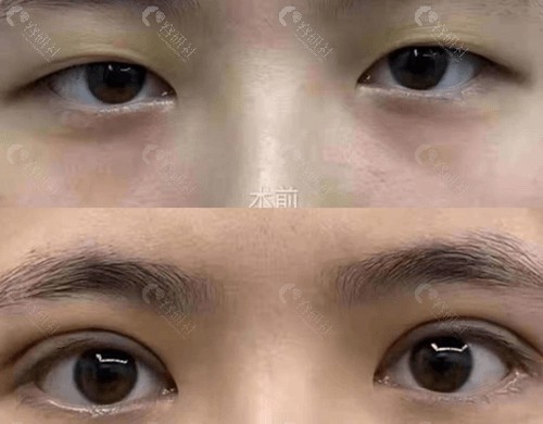 丹东富雅华医整形割双眼皮对比照