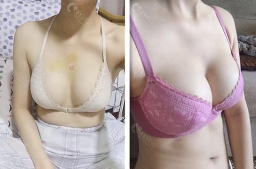 韩国普罗菲耳隆胸修复前后对比照