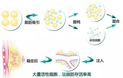 同荣脂雕丰胸术与一般自体脂肪丰胸有什么不同？同荣脂雕丰胸术原理