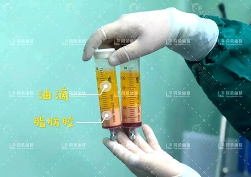杭州同荣丽格医疗美容医院同荣脂雕术取脂图片