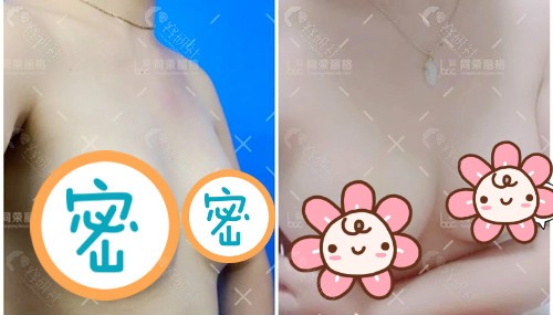 杭州同荣丽格自体脂肪丰胸术前术后图片