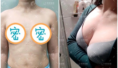 杭州同荣丽格自体脂肪丰胸术前后对比图