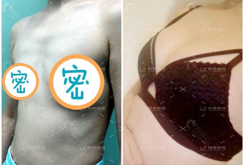 杭州同荣丽格自体脂肪丰胸术后图片