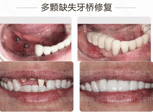 北京中诺口腔种植牙对比照