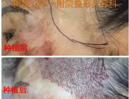 南昌大学一附院疤痕头发种植术前术后对比图