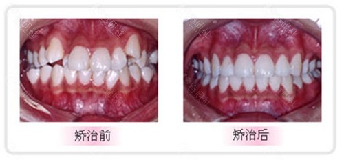广安市华蓥市何氏口腔牙齿矫正术前术后对比图