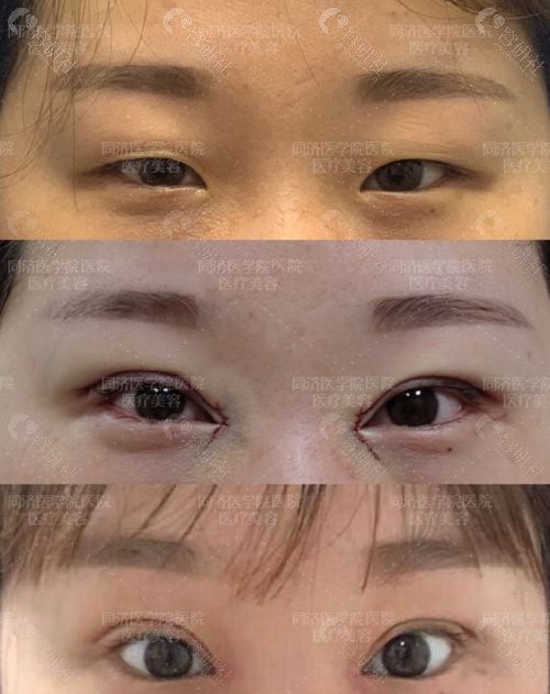 武汉同济医院陈平双眼皮手术前后对比照