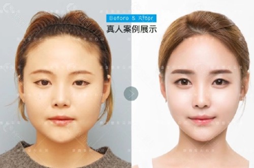 上海首尔丽格石润医生下颌角发达改善前后对比图