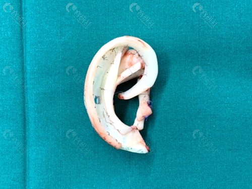 郭树忠教授用肋软骨雕刻出来的耳支架