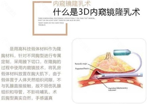 乌鲁木齐华美3D内窥镜隆胸术优势介绍