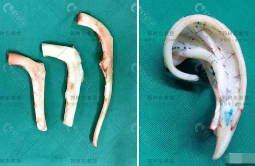 肋软骨支架再造耳是如何与耳旁组织连接起来的？