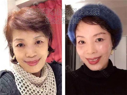 北京黄寺医疗美容外科医院杜太超面部除皱前后对比图