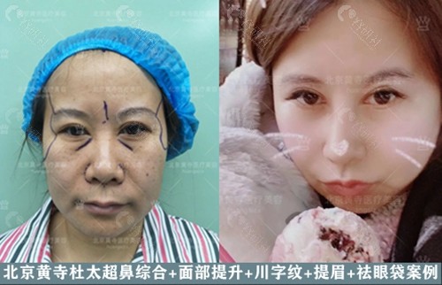 北京黄寺杜太超鼻综合+面部提升+川字纹+提眉+祛眼袋前后对比图