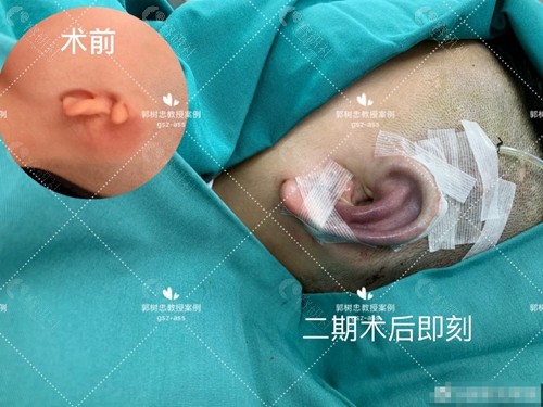 西安国医中心郭树忠耳朵畸形修复照片