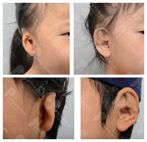 韩国普罗菲耳耳朵畸形修复示例