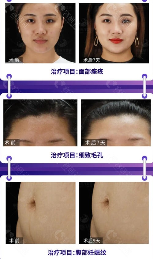 北京丽都医疗美容医院黄金微针治疗痤疮、细致毛孔、腹部妊娠纹前后对比图