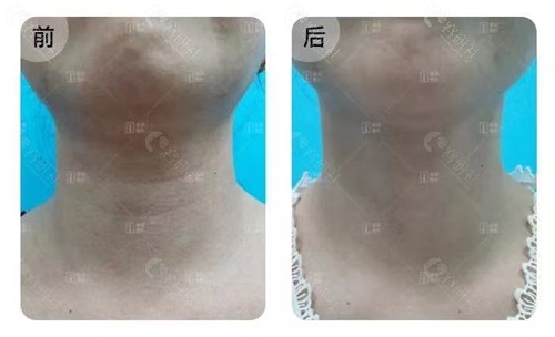 北京画美医疗美容医院治疗前及1次治疗后颈纹明显改善，肤质变得细腻