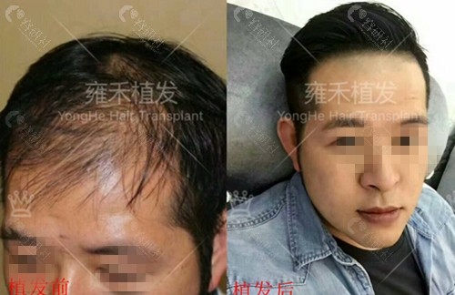 贵阳雍禾男士植发术前术后对比图