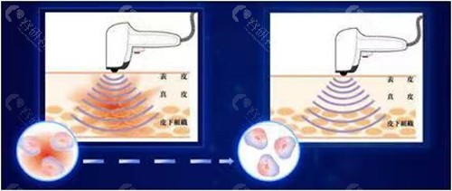 黄金微针治疗腋臭一般要做几次？不同程度腋臭疗程不同