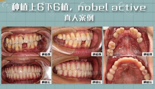 上海九院口腔科种植牙前后对比照