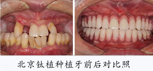 北京钛植种植牙术前术后对比