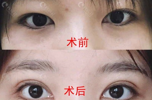 郑州中心医院暴志国医生双眼皮术前术后对比图