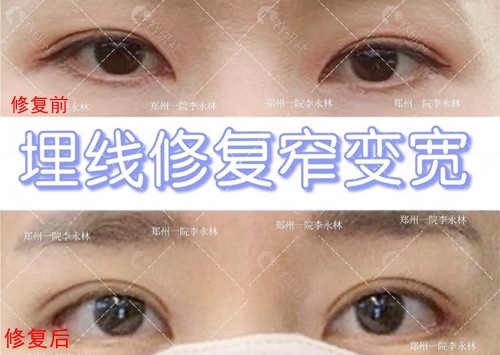 郑州第 一人民医院李永林医生埋线双眼皮修复术前术后对比图