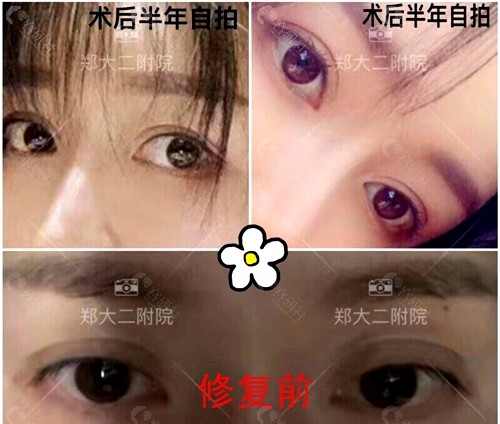 郑州大学第二附属医院刘月更医生双眼皮修复术前术后对比图
