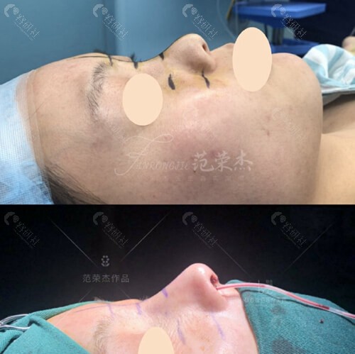 上海联合丽格范荣杰隆鼻术后即刻照片