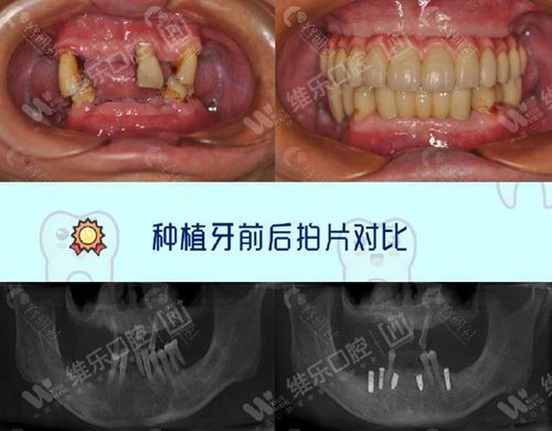 维乐口腔种植牙对比照