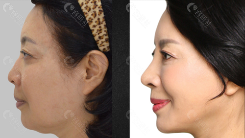 何阿姨在韩国必当归做面部提升术后侧面对比