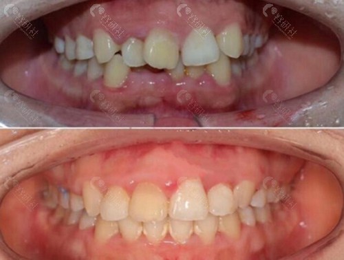 上海松丰牙齿正畸术前术后对比
