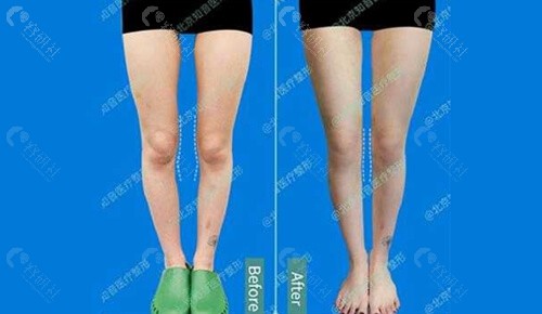 北京知音医疗美容O型腿矫正对比照