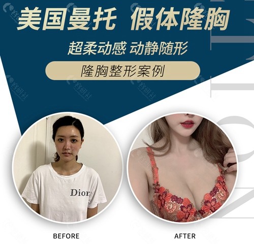 上海仁爱医院胸部整形前后对比图