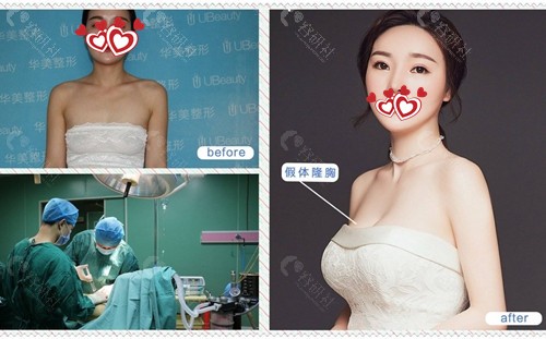 合肥华美整形外科医院假体隆胸术前术后对比图