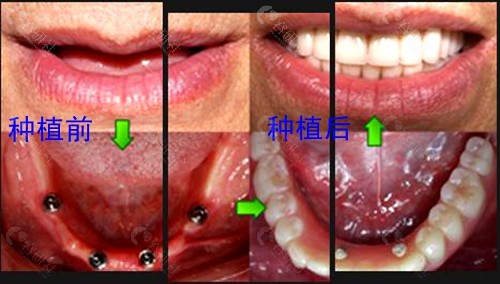 全口种植牙术前术后对比图