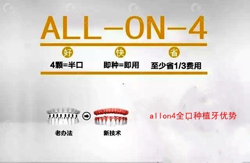 allon4全口种植牙技术优势