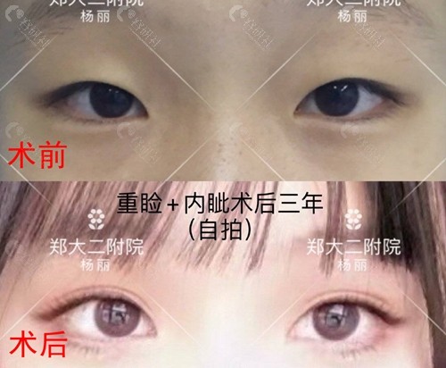 郑州大学第二附属医院双眼皮术前术后对比图