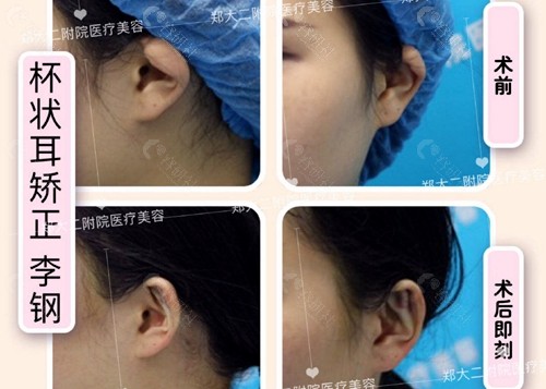 郑州大学第二附属医院杯状耳矫正术前术后对比图