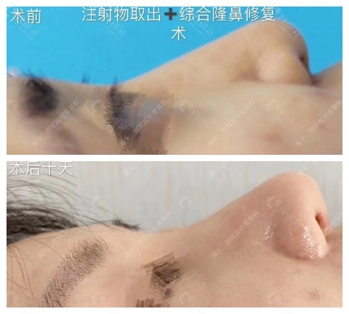 郑大二附院李刚医生做鼻部注射物取出修复术前术后对比图